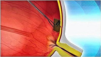 Una minúscula retina biónica restablecerá la vista a los ciegos