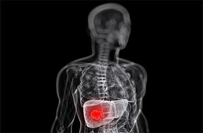 Científicos descubren posible vía para frenar el cáncer de hígado