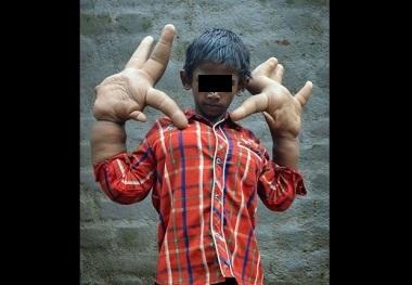 Niño de la India tiene manos gigantes y sufre de bullying