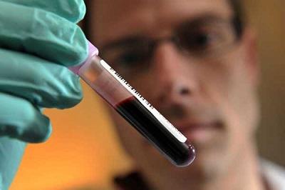 Un análisis de sangre detecta un 86% de los cánceres de ovarios