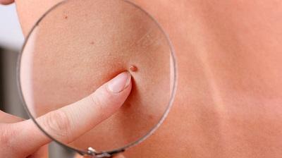 Una modificación del virus del herpes destruye las células del cáncer de piel