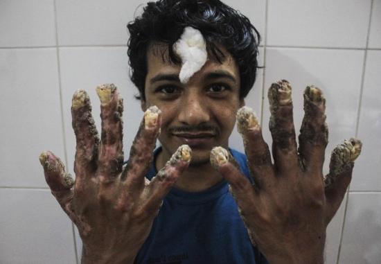 El hombre árbol de Bangladesh tiene nuevas manos