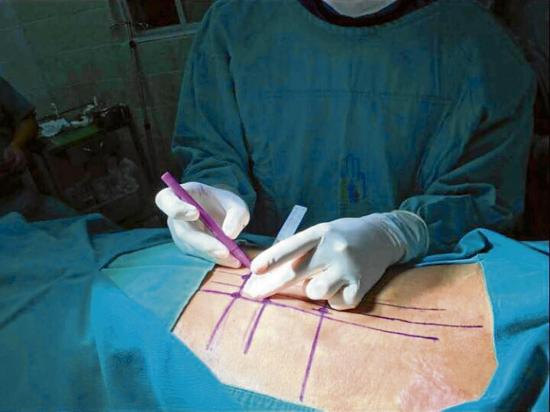 Dos cirugías evitan  cicatrices profundas