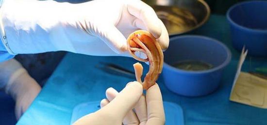 Joven recibe un implante de oreja creado con el cartílago de su madre