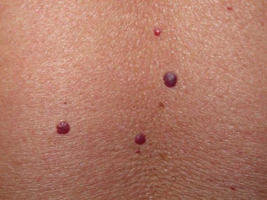 ¿Son peligrosos los puntos rojos en la piel?