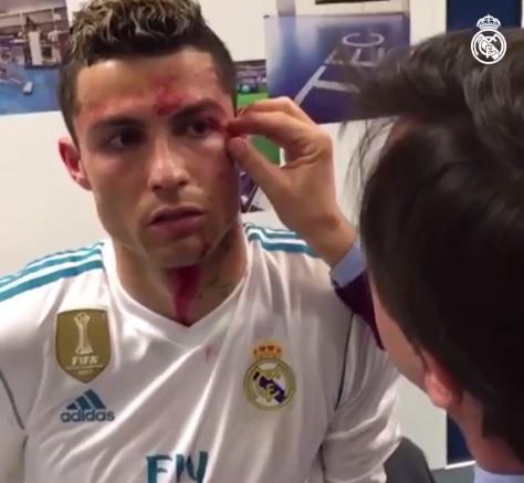 ¡FUERTE! Mira cómo fue la herida que Cristiano Ronaldo sufrió ante el Deportivo