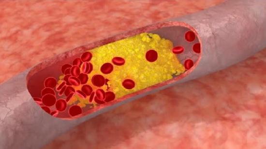 Treinta millones de personas en el mundo nacen con el colesterol alto