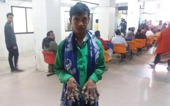 El ''hombre árbol'' de Bangladesh vuelve al hospital sin esperanzas de curación