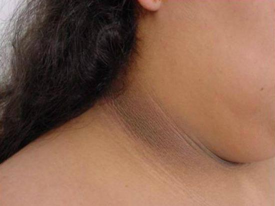 Oscurecimiento de parte posterior del cuello, alerta de prediabetes: experto