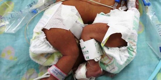 Una dominicana de 32 años da a luz a siamesas en un hospital de Santo Domingo