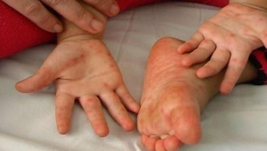 30 casos del  virus manos, pies y boca