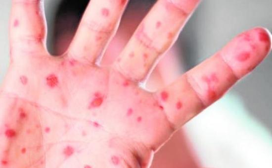 EEUU registra un récord mensual de ocho casos de sarampión dentro del peor brote desde 1992