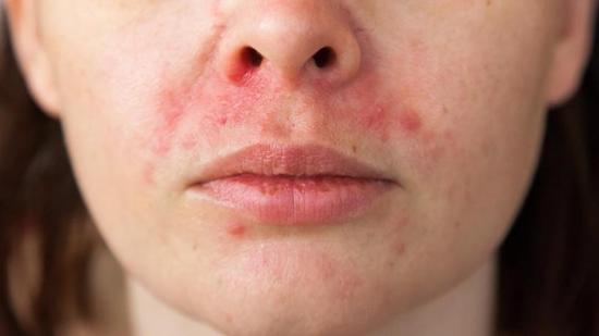 Dermatitis, acné y rosácea, enfermedades de la piel agravadas por el uso de mascarillas y geles
